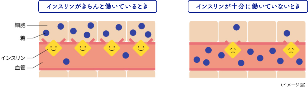 「インスリン分泌低下」イメージ 「インスリン抵抗性」のイメージ