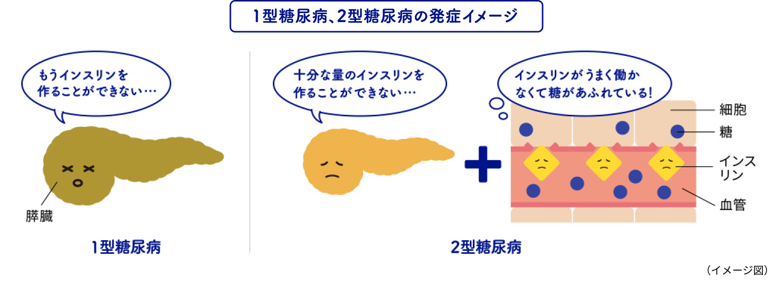 1型糖尿病、2型糖尿病の発症イメージ